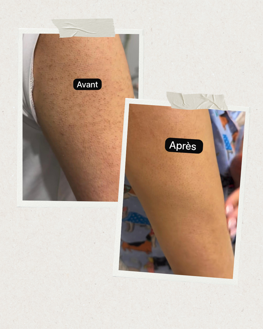 Lunéa™ – Gant Anti Peau de Fraise